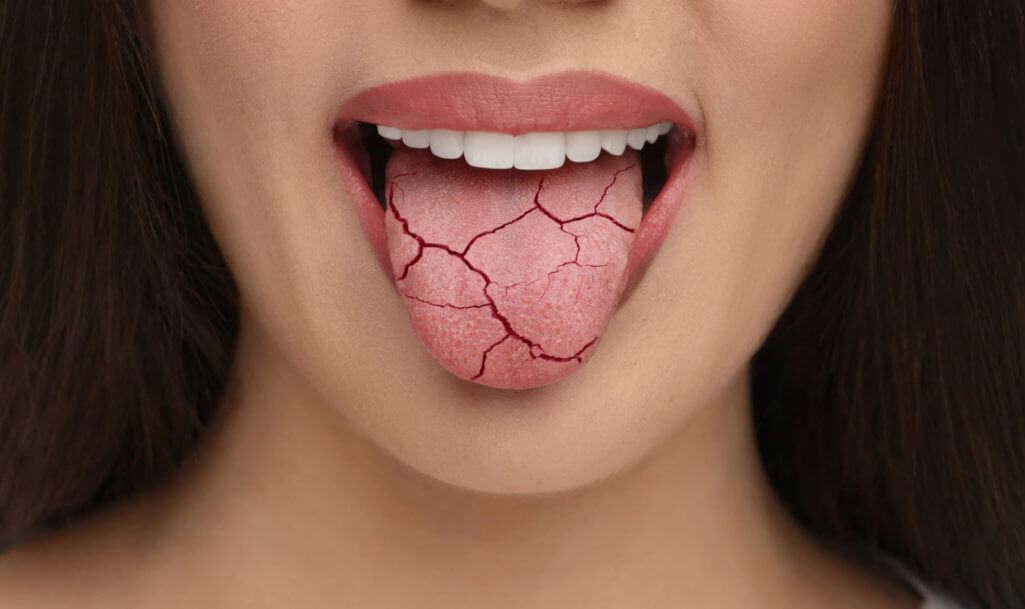 Dry mouth symptom. Woman showing dehydrated tongue, closeup